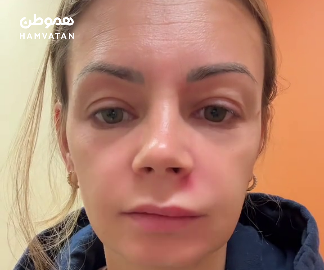 از یک جوش کوچک تا ورم شدید صورت: تجربه وحشتناک یک زن آمریکایی